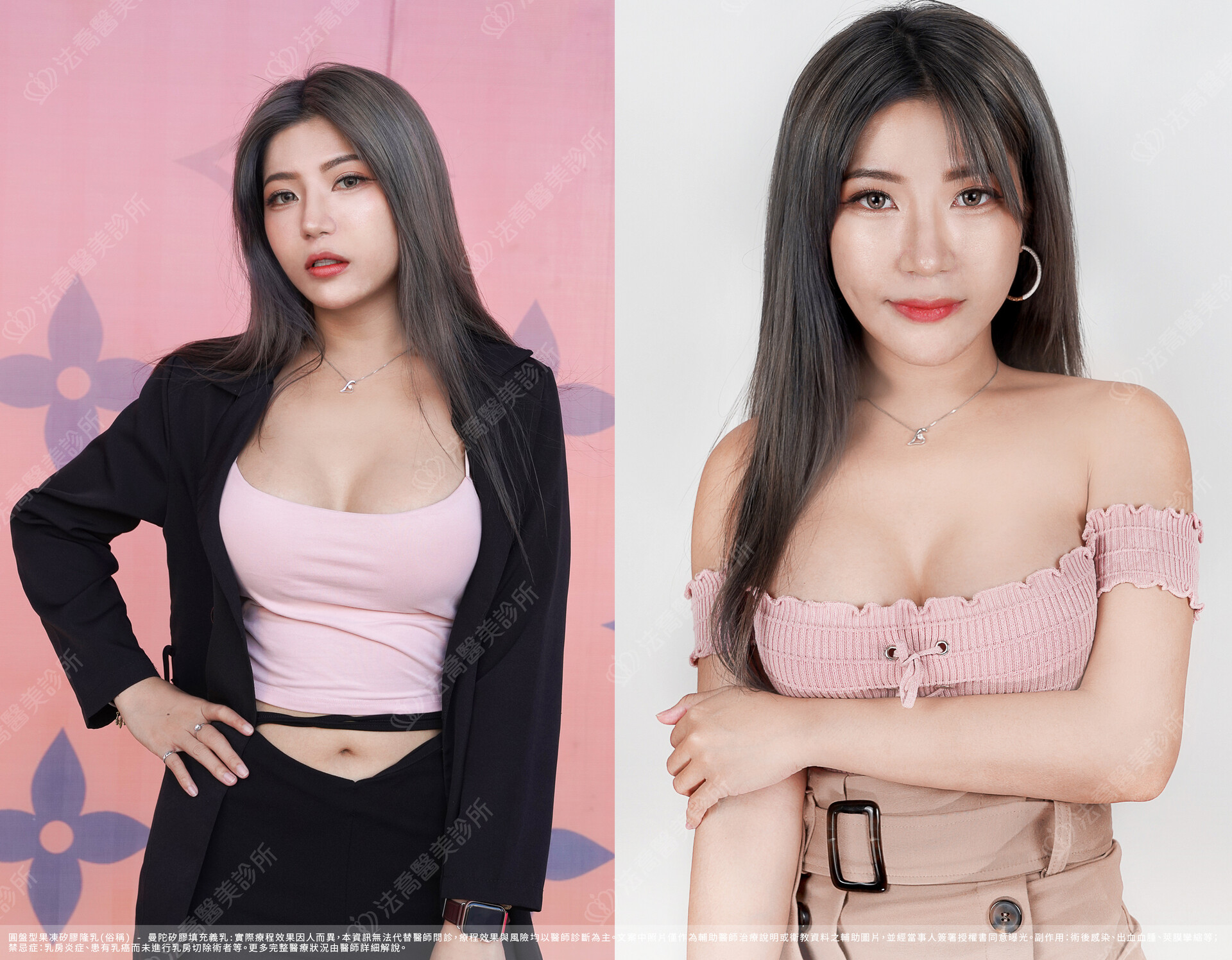 隆乳