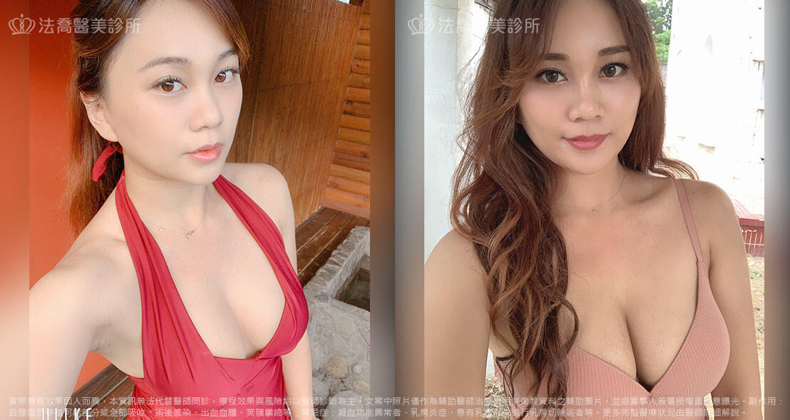 高雄法喬醫美,邱浚彥,威塑抽脂,自體脂肪豐胸