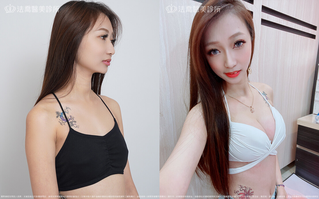 法喬醫美診所,邱浚彥,魔滴隆乳,隆乳推薦