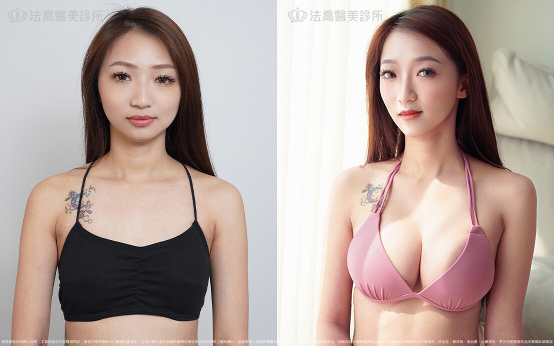 法喬醫美診所,邱浚彥,魔滴隆乳,隆乳推薦