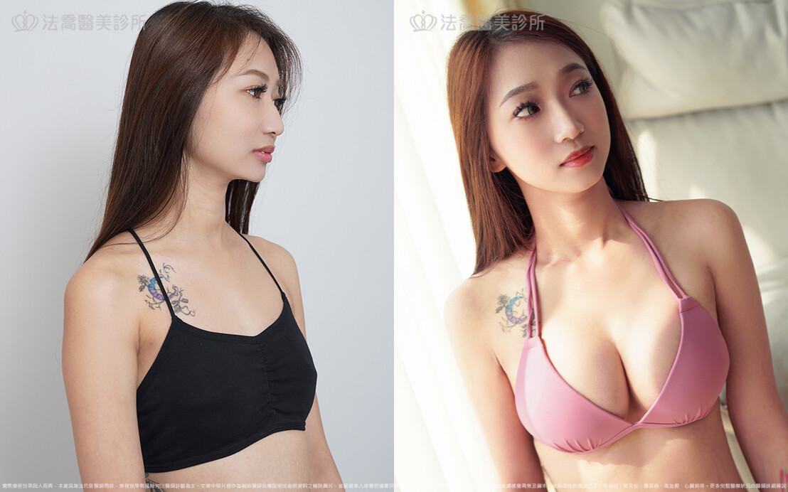 法喬醫美診所,邱浚彥,魔滴隆乳,隆乳推薦