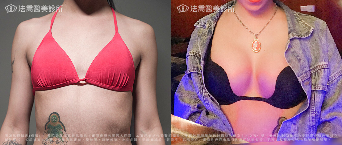 美美隆乳手術1個月