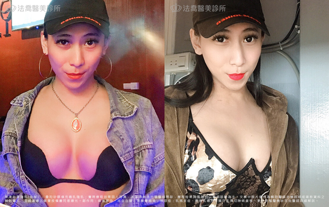 美美隆乳術後1個月生活照