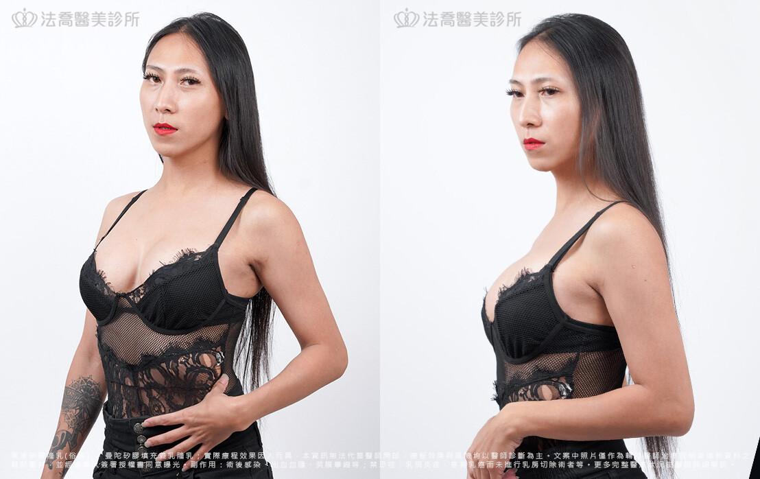 美美隆乳術後6個月生活照