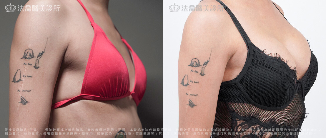 美美隆乳術後6個月2