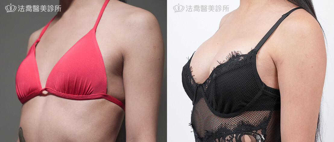 美美隆乳術後6個月3