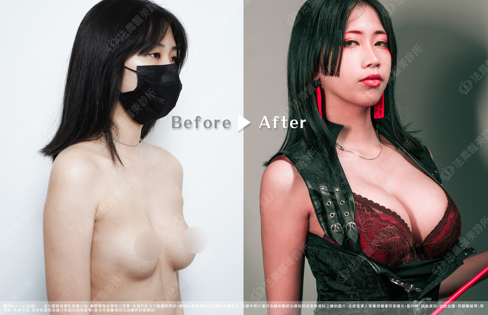 法喬醫美診所,邱浚彥,魔滴隆乳,隆乳推薦