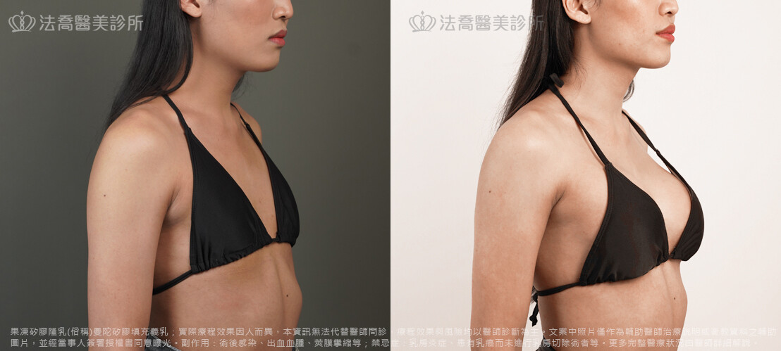 圓盤果凍矽膠隆乳 / 術前與術後3個月