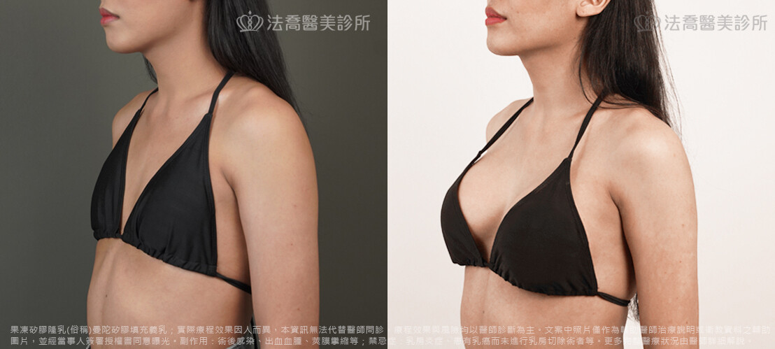 圓盤果凍矽膠隆乳 / 術前與術後3個月