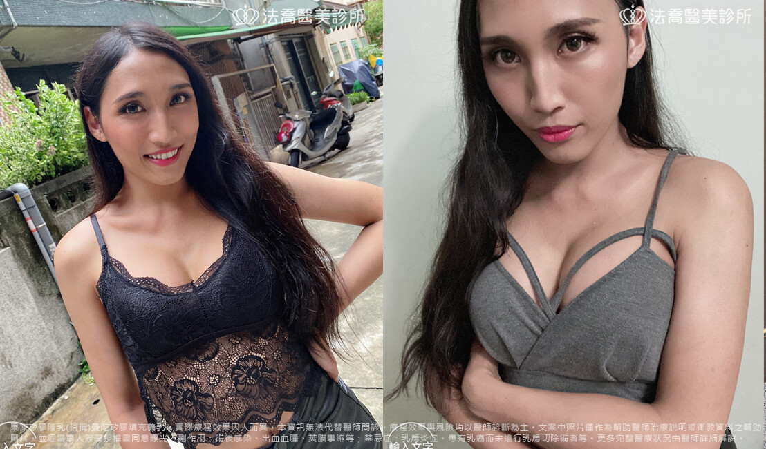 圓盤果凍矽膠隆乳 / 術後3個月生活照