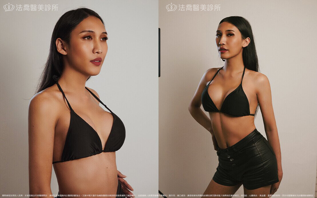 圓盤果凍矽膠隆乳 / 術後3個月生活照