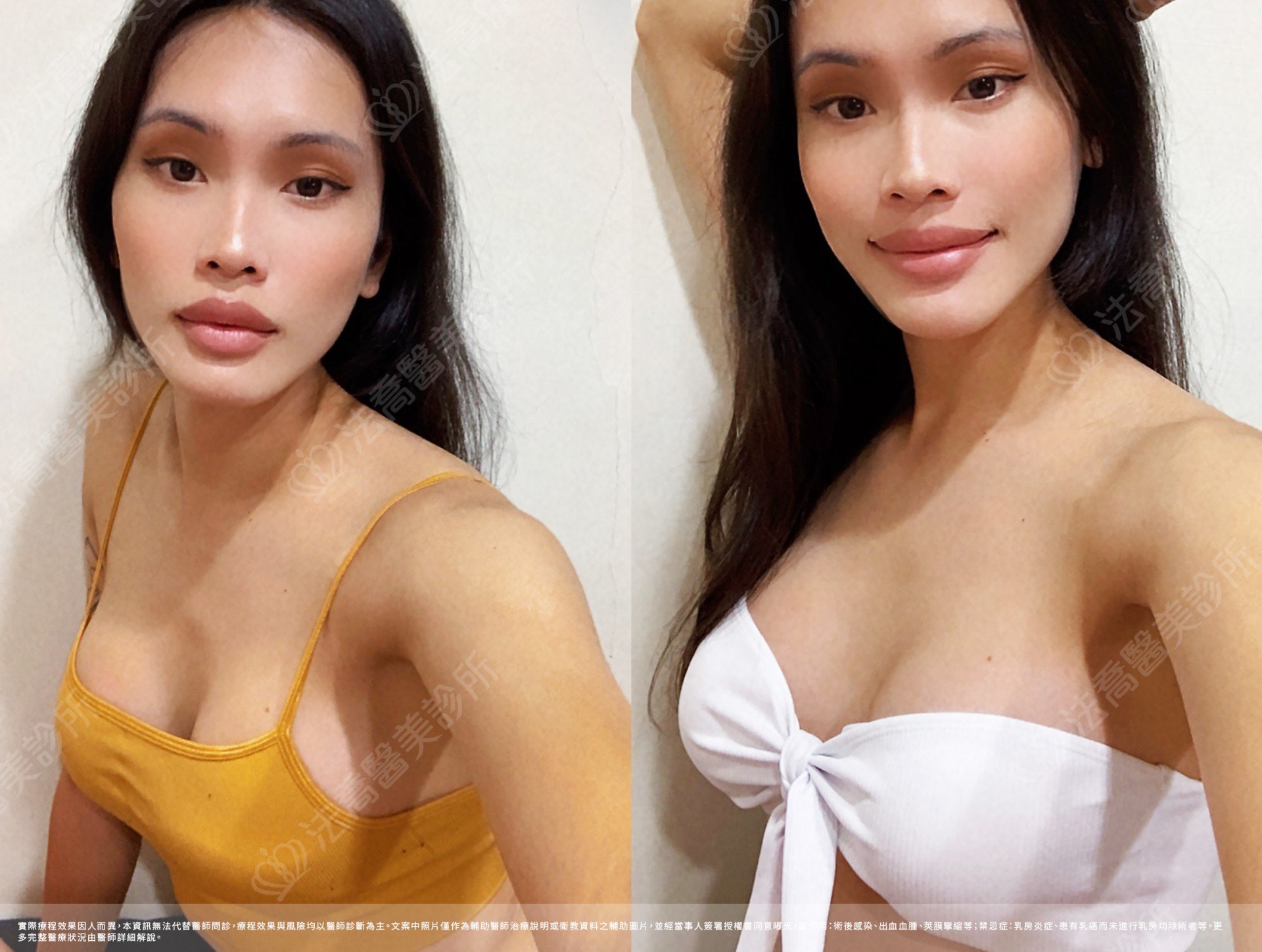 兔兔隆乳術後1個月生活照