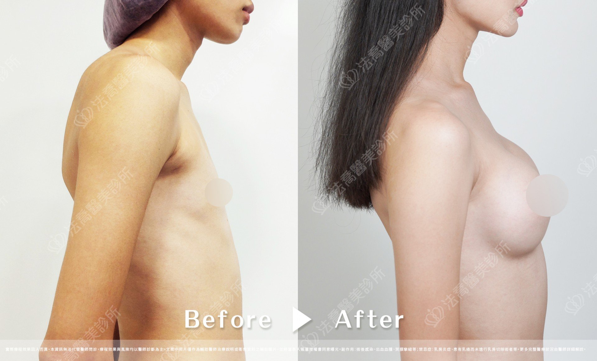 兔兔隆乳術後3個月C
