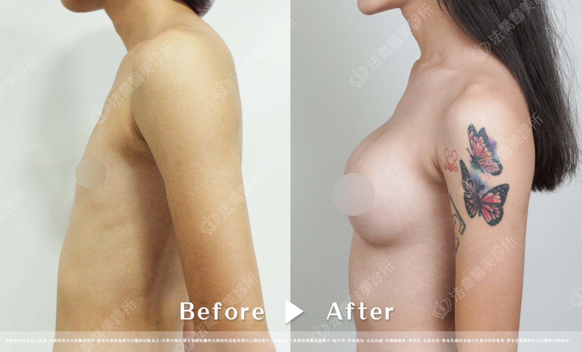 兔兔隆乳術後3個月D