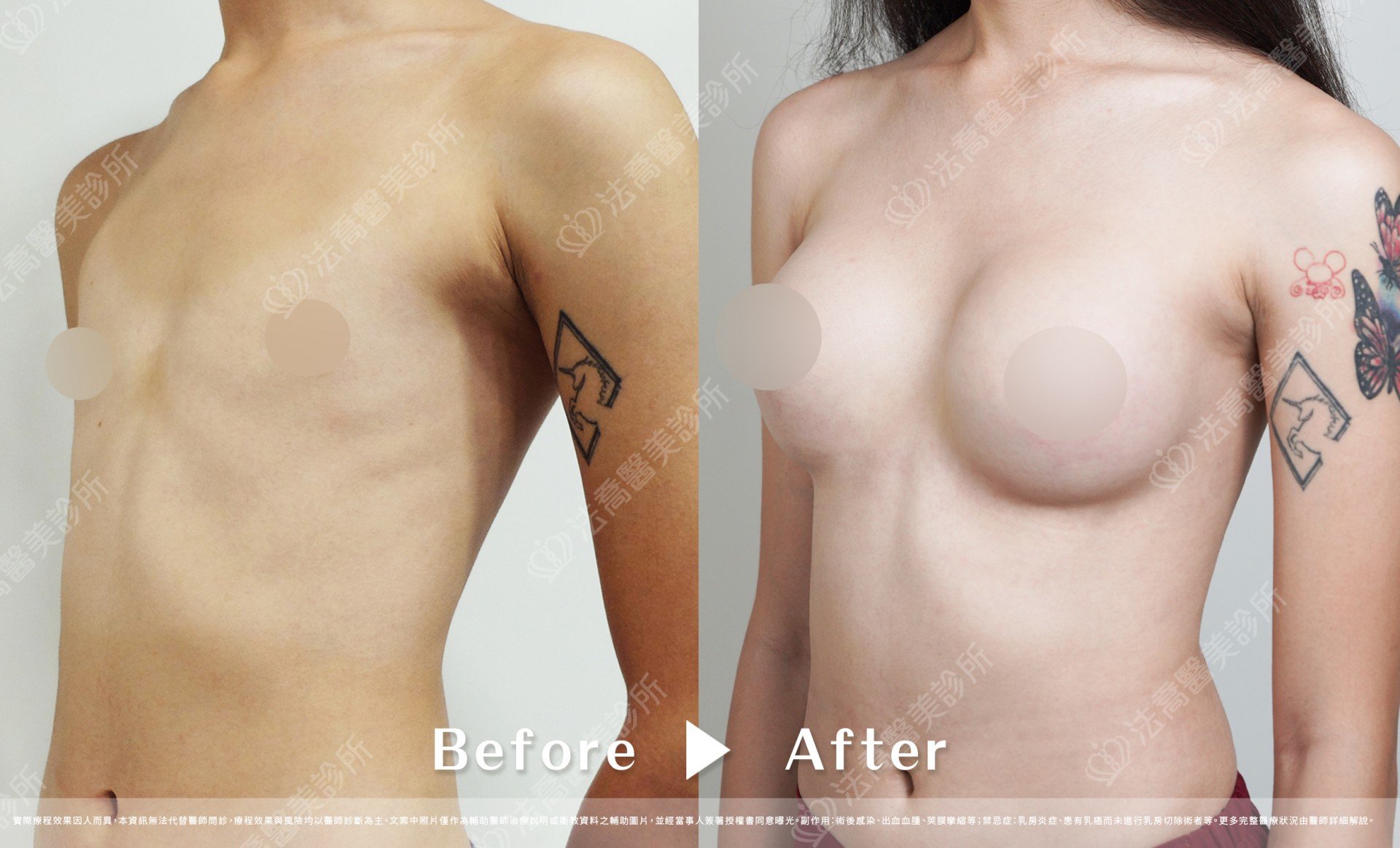 兔兔隆乳術後3個月A