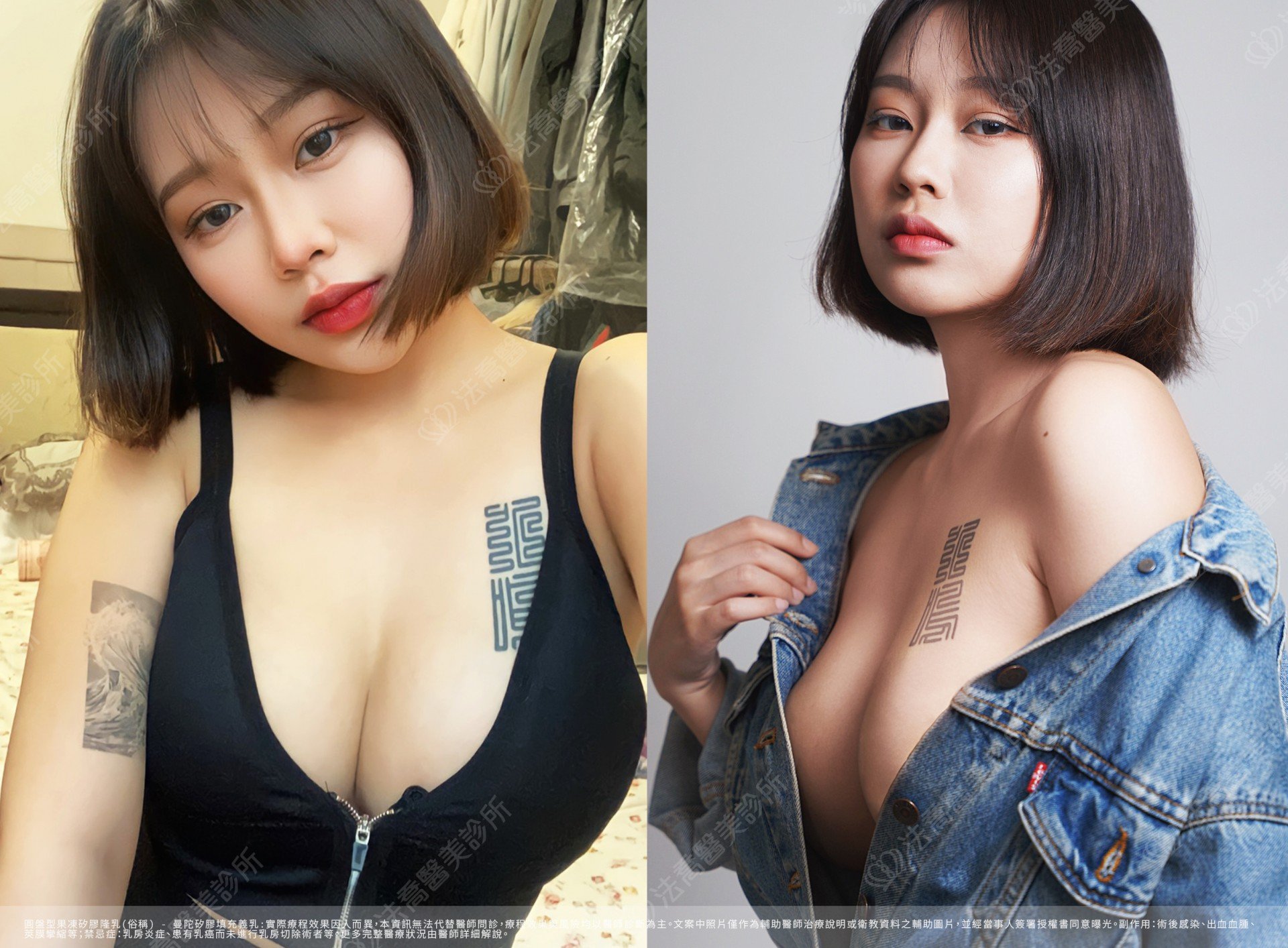 隆乳