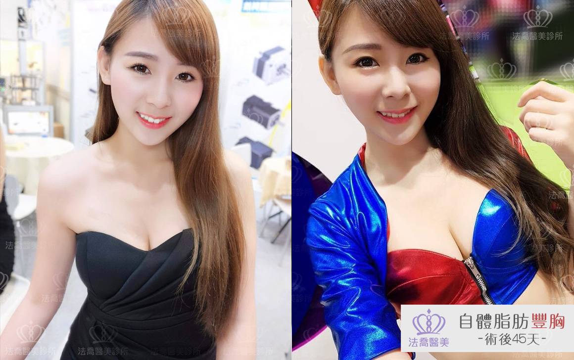 法喬醫美診所-自體脂肪豐胸
