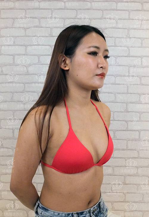 法喬醫美診所_複合式隆乳術前照