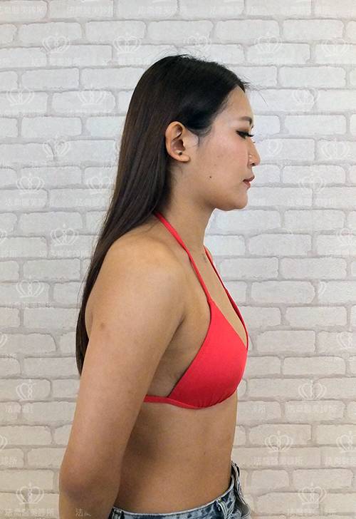 法喬醫美診所_複合式隆乳術前照