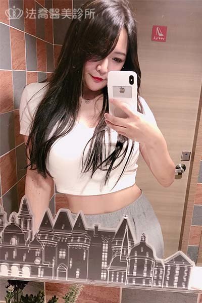 自體肋骨隆鼻