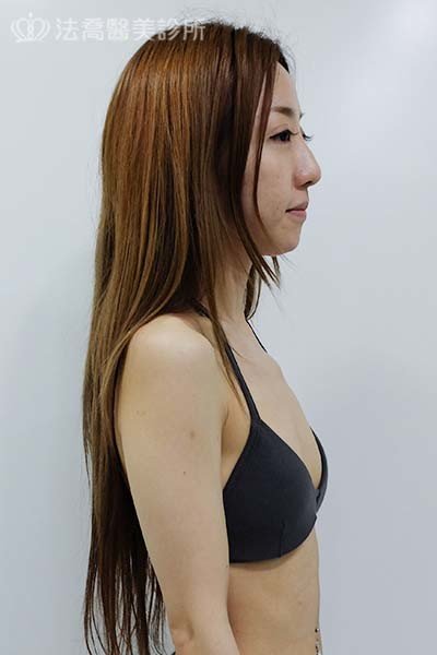 水滴型果凍矽膠隆乳