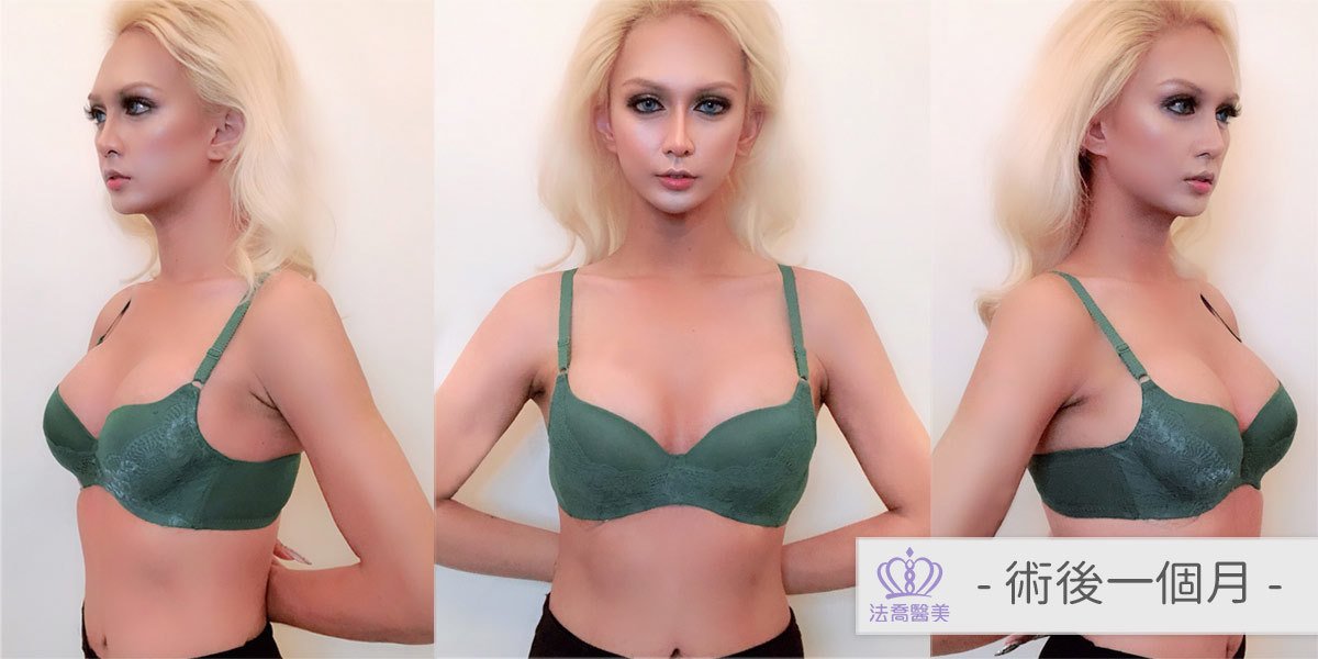 法喬醫美診所複合式隆乳