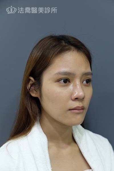自體肋骨隆鼻
