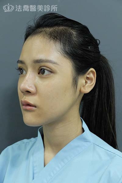 自體肋骨隆鼻