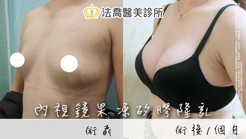 內視鏡果凍矽膠隆乳