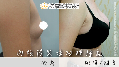 內視鏡果凍矽膠隆乳