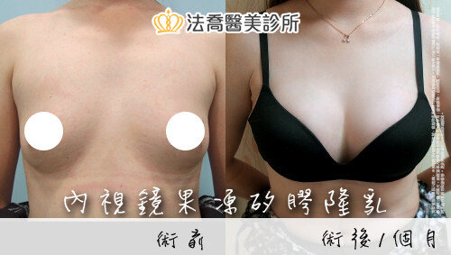 內視鏡果凍矽膠隆乳