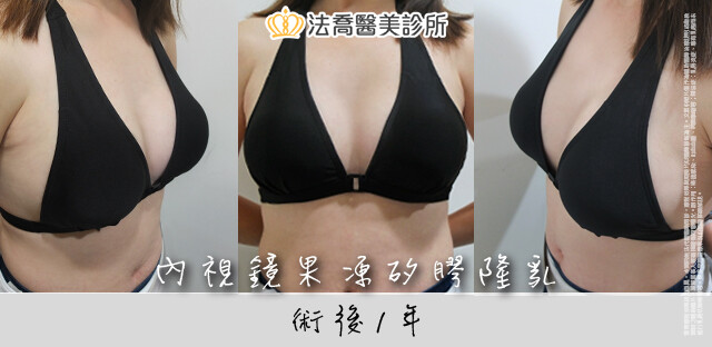 內視鏡果凍矽膠隆乳