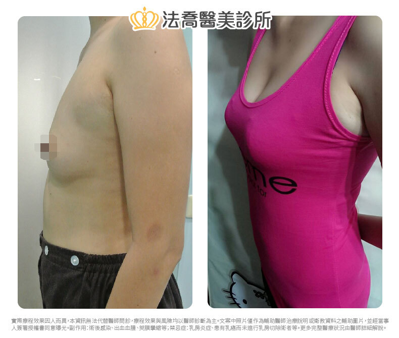 隆乳推薦