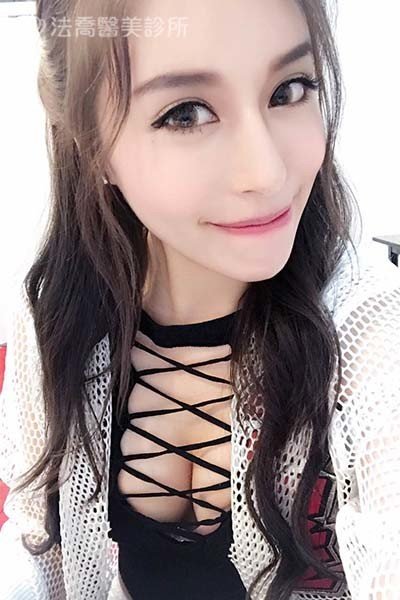 自體肋骨隆鼻