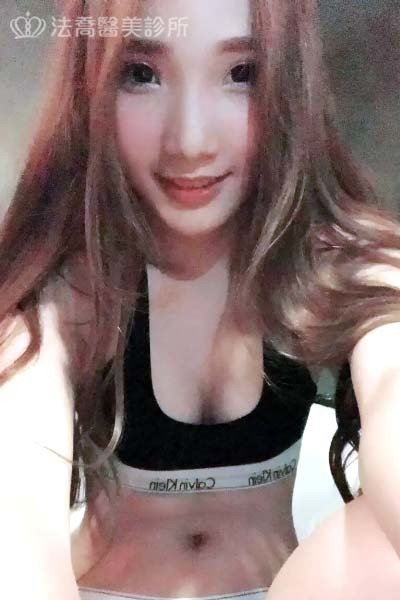 自體肋骨隆鼻