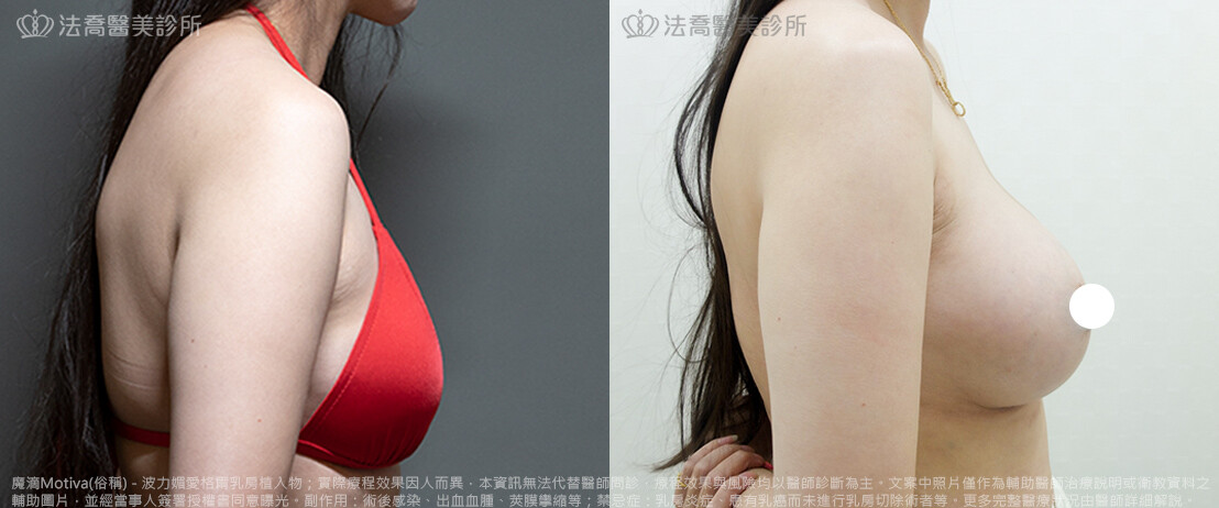法喬醫美診所,邱浚彥,魔滴隆乳,隆乳推薦
