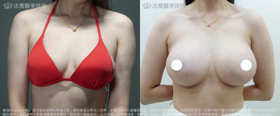 法喬醫美診所,邱浚彥,魔滴隆乳,隆乳推薦