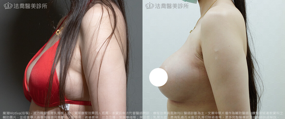 法喬醫美診所,邱浚彥,魔滴隆乳,隆乳推薦