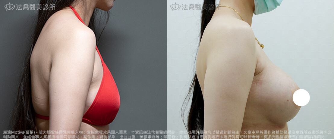 法喬醫美診所,邱浚彥,魔滴隆乳,隆乳推薦