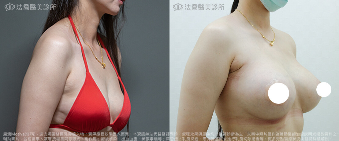 法喬醫美診所,邱浚彥,魔滴隆乳,隆乳推薦