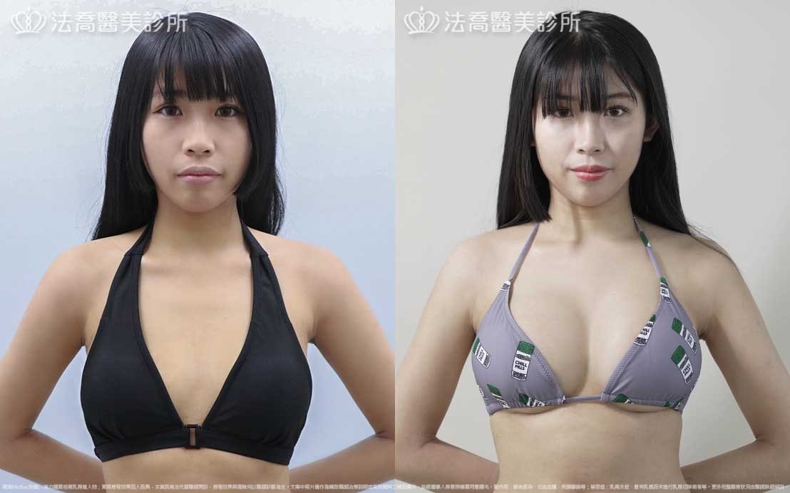 法喬醫美診所,邱浚彥,魔滴隆乳,隆乳推薦