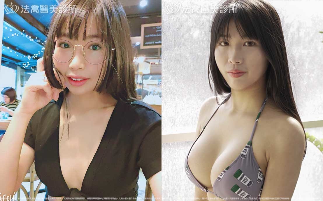 法喬醫美診所,邱浚彥,魔滴隆乳,隆乳推薦