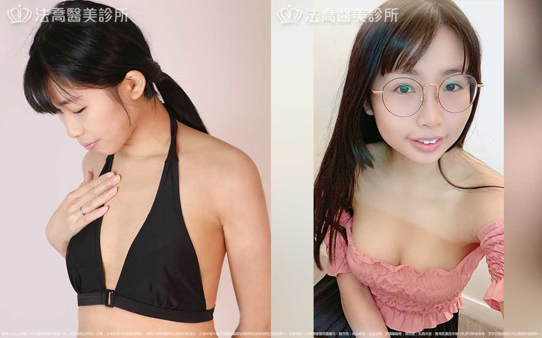 法喬醫美診所,邱浚彥,魔滴隆乳,隆乳推薦