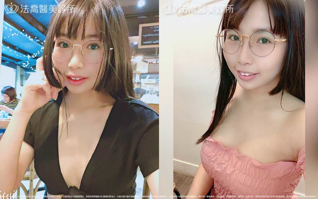 法喬醫美診所,邱浚彥,魔滴隆乳,隆乳推薦