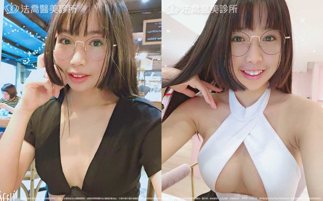 法喬醫美診所,邱浚彥,魔滴隆乳,隆乳推薦