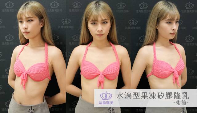 法喬醫美診所-水滴型果凍矽膠隆乳