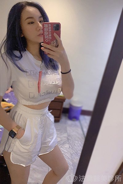 法喬醫美診所魔滴隆乳術後最新案例