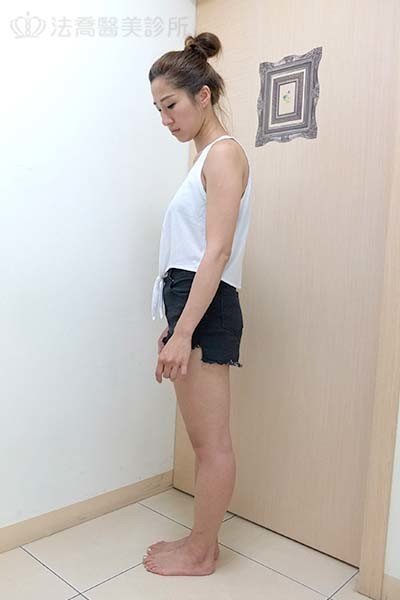 自體肋骨隆鼻