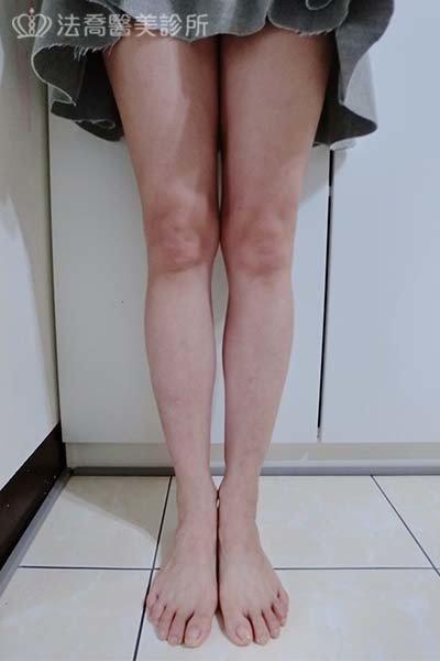 自體肋骨隆鼻