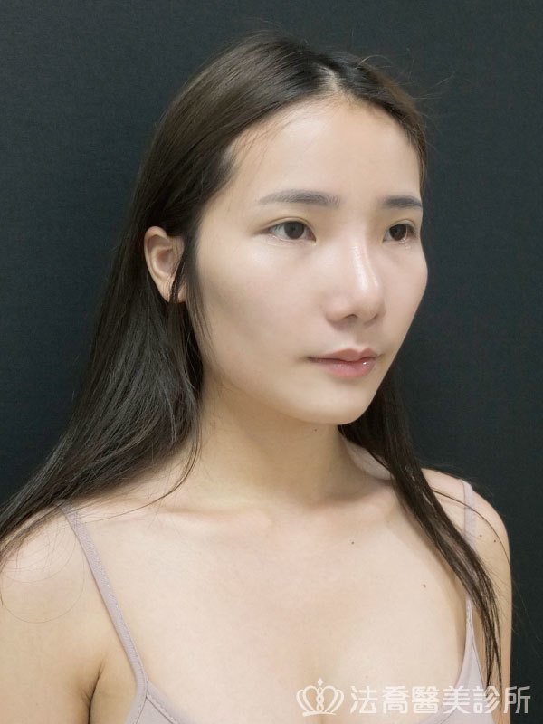 自體肋骨隆鼻